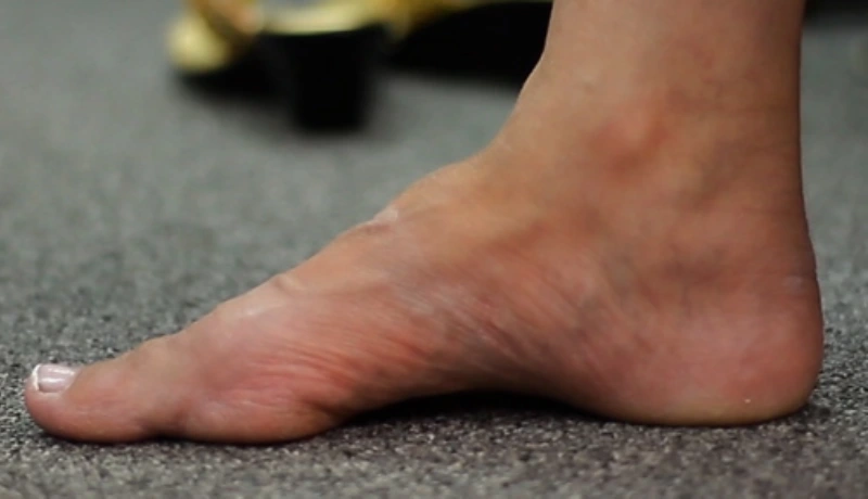 درمان صافی کف پا با اسکن پا