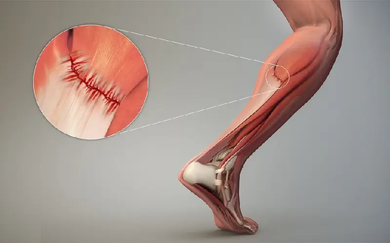 پیشگیری از درد ساق پا