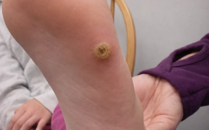 علت ایجاد میخچه
