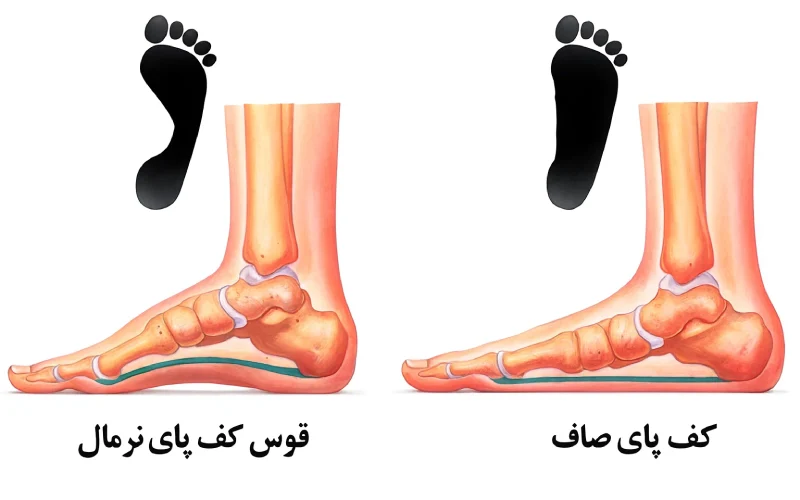 علل صافی کف پا در کرج 