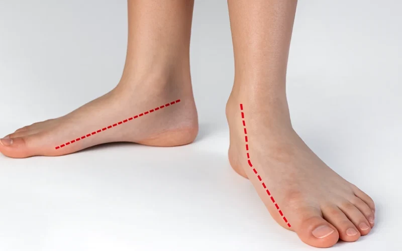 روش های درمان صافی کف پا در کرج