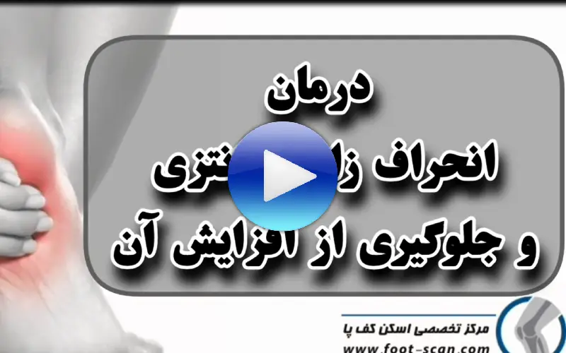 درمان انحراف زانوی پرانتزی با فوت اسکن