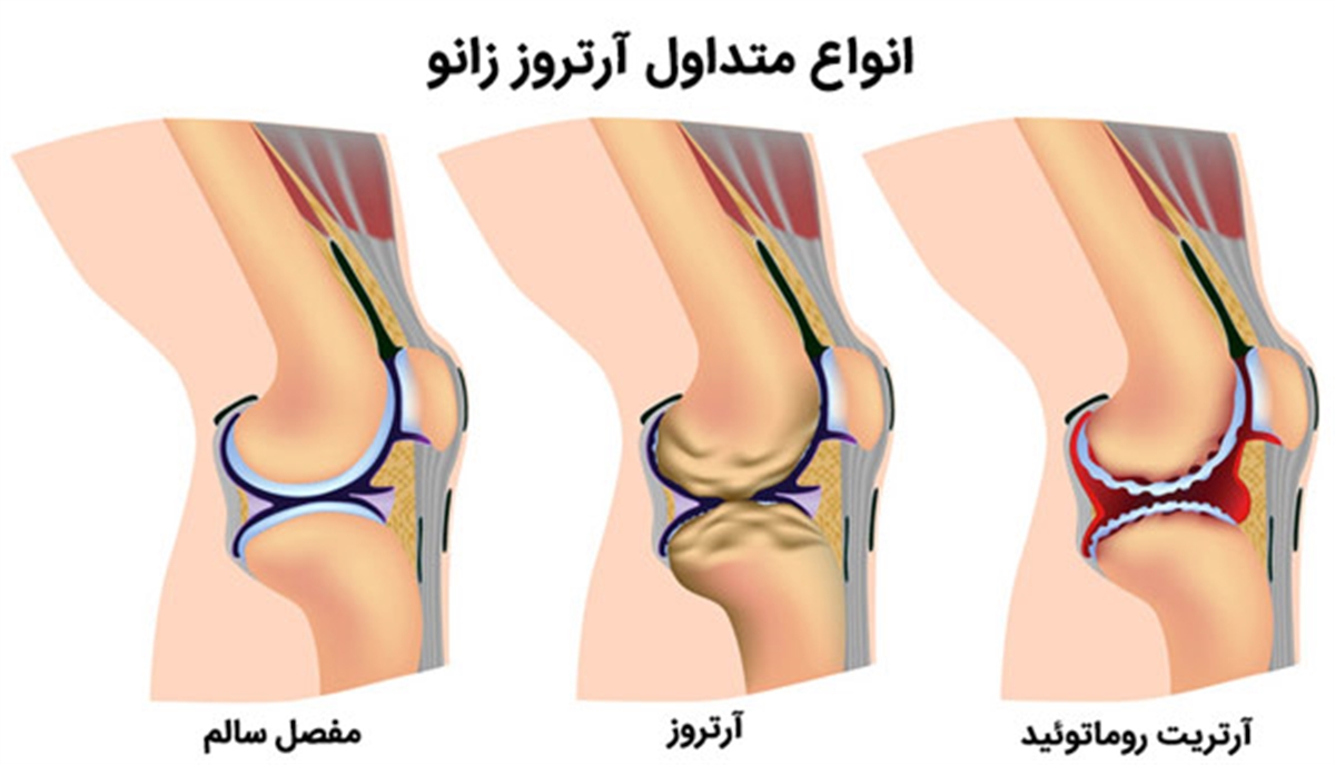 درمان آرتروز زانو در تهران, درمان آرتروز زانو در کرج