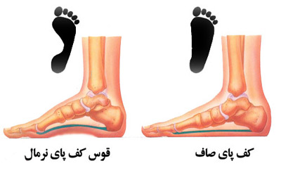 درمان صافی کف پا در کرج, درمان صافی کف پا در تهران