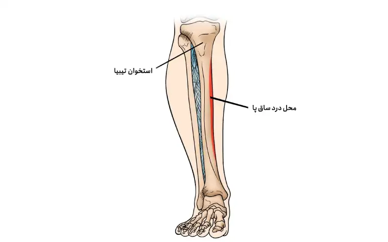 نشانه های درد ساق پا