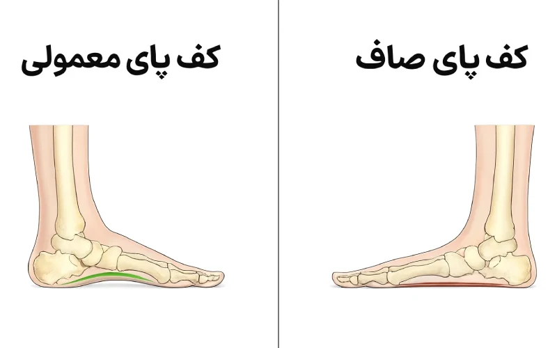 عواقب عدم درمان صافی کف پا در تهران