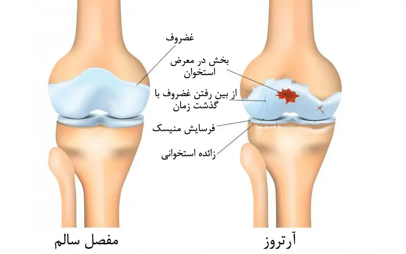 Treatment of knee osteoarthritis pain without surgery in Tehran درمان درد آرتروز زانو بدون جراحی در تهران