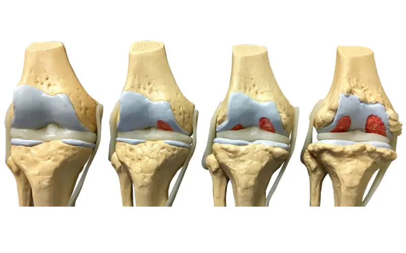 درمان آرتروز زانو بدون جراحی در تهران