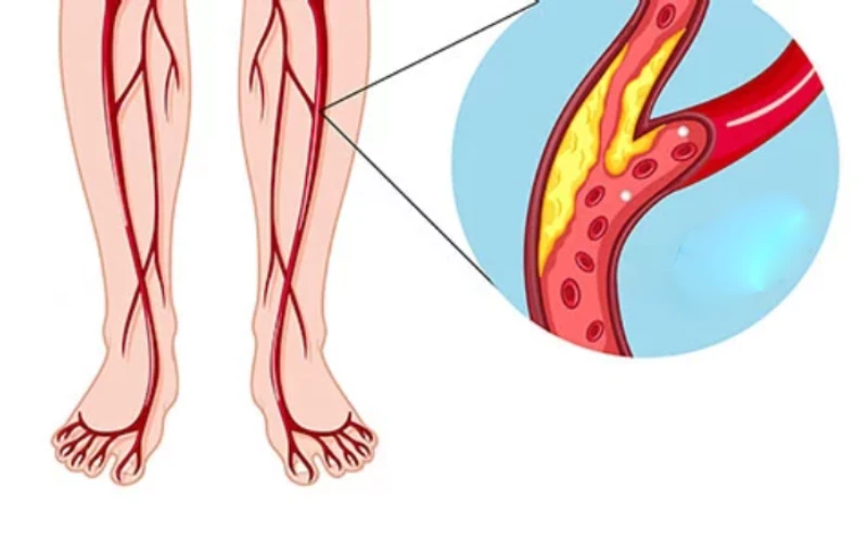 درمان درد ساق پا درتهران