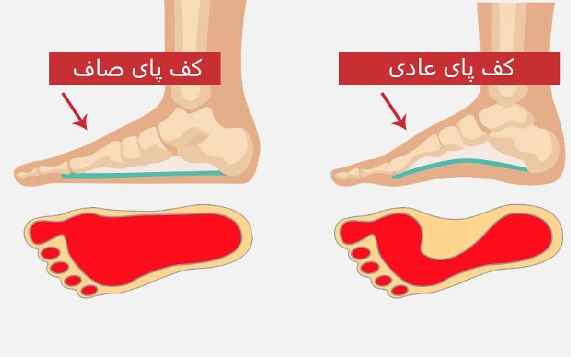 Corrective exercises for flat feet حرکات اصلاحی کف پای صاف