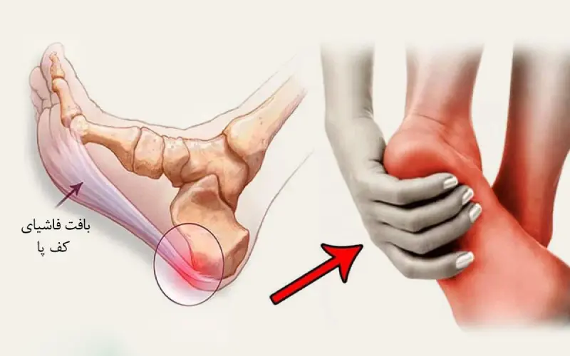 خار پاشنه در تهران