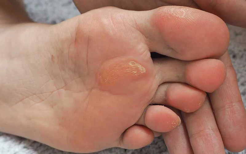 چگونه از میخچه پا جلوگیری کنیم؟