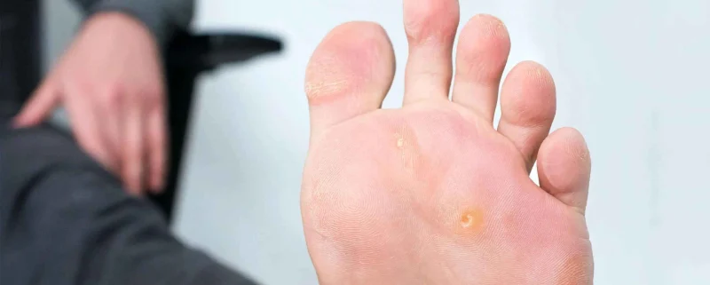 What is a corn_ _ Complications, causes and treatment of corns on the feet میخچه چیست؟ | عوارض، علت و درمان درمان میخچه پا