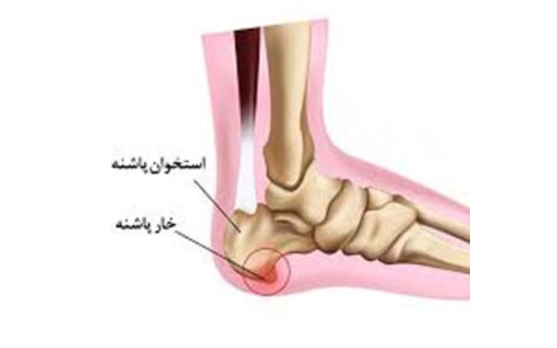 درمان خار پاشنه