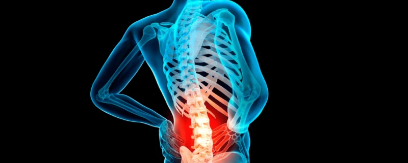 دیسک و اعصاب سیاتیک