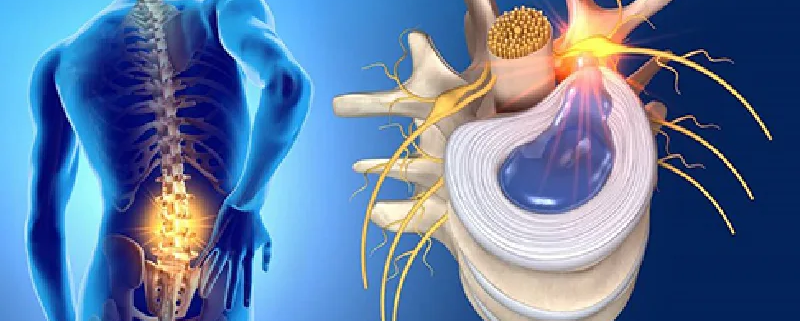 درمان دیسک کمر