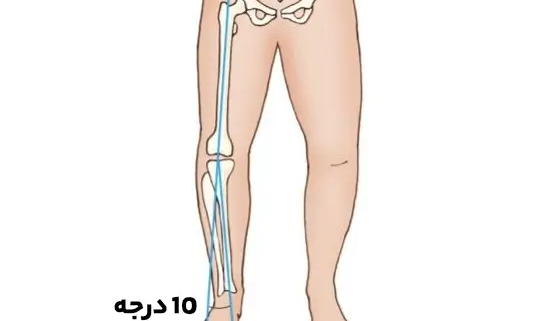 درمان زانو پرانتزی