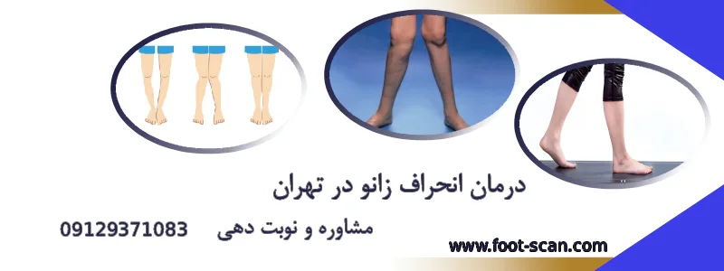 درمان انحراف زانو در تهران
