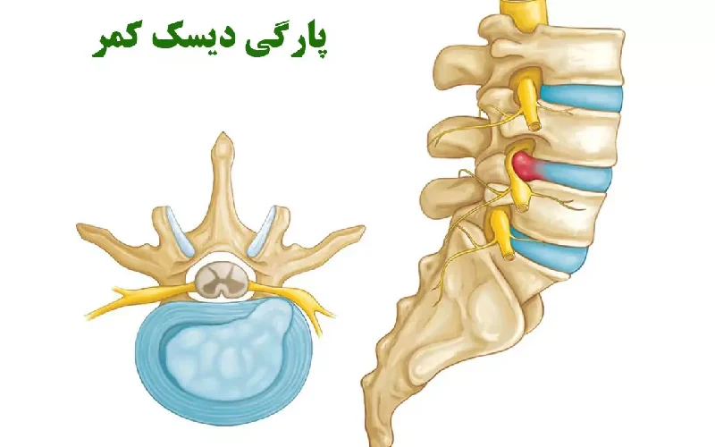 پارگی دیسک کمر در کرج