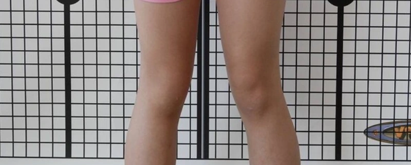 درمان انحراف زانو در تهران