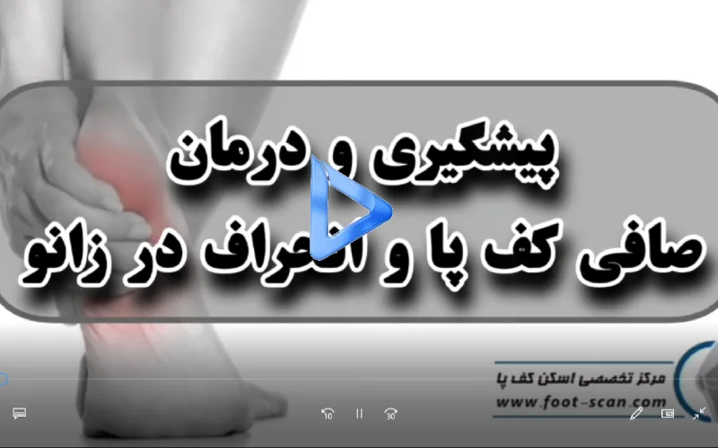 پیشگیری و درمان انحراف زانو