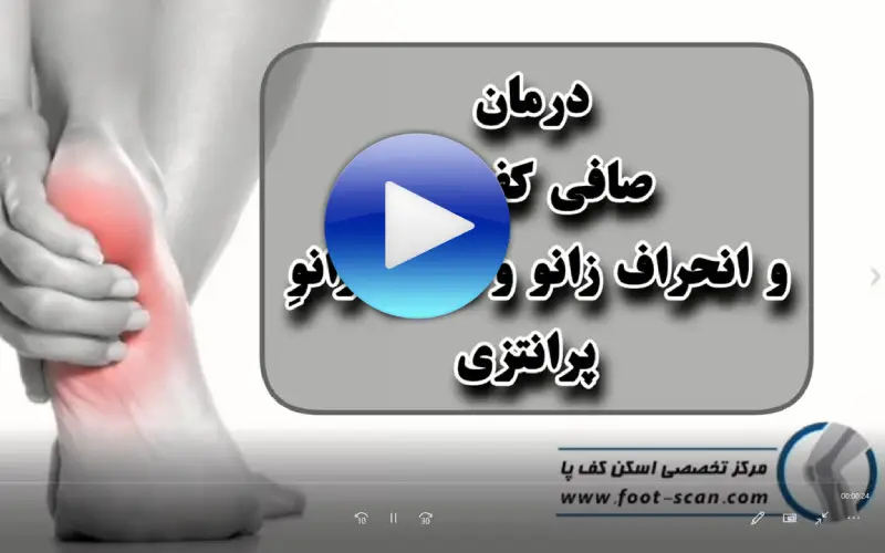 درمان صافی کف پا و انحراف زانو