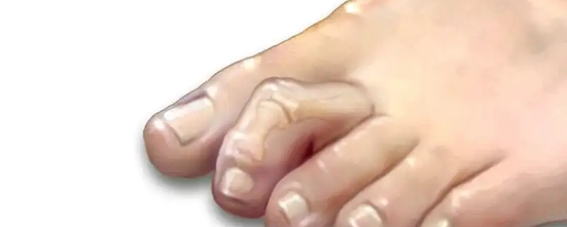 انگشت چگالی پا