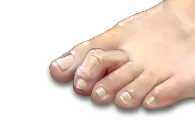انگشت چگالی پا