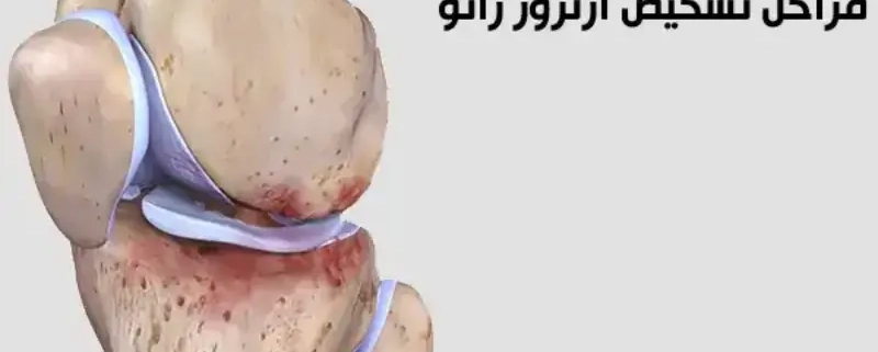آرتروز یا ساییدگی زانو چیست؟