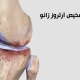 آرتروز یا ساییدگی زانو چیست؟