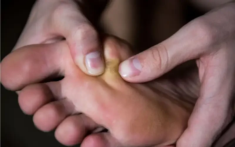 میخچه چه عوارضی می‌تواند ایجاد کند؟