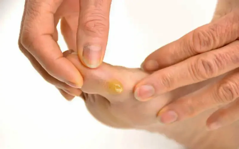 میخچه در کدام قسمت پا تشکیل می‌شود؟