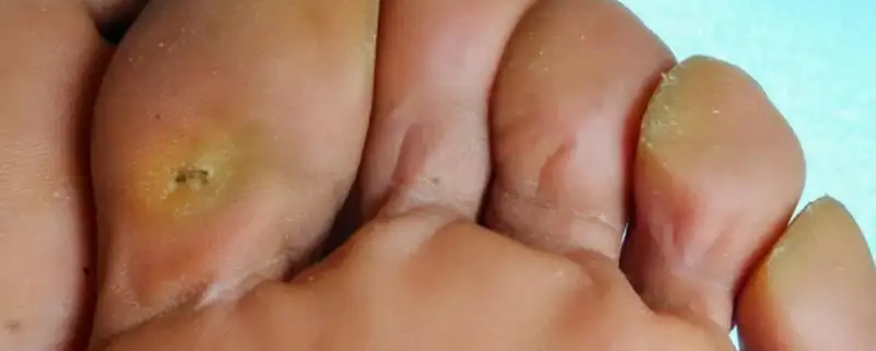 درمان میخچه پا در کرج