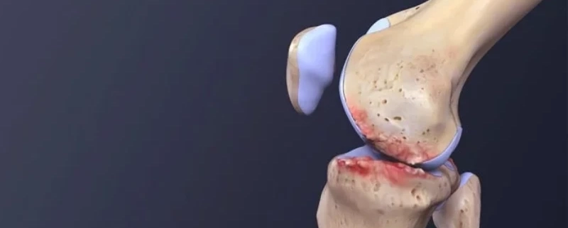 درمان آرتروز