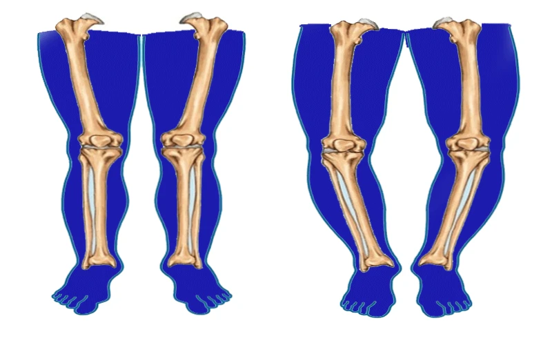 روش های درمان پای پرانتزی