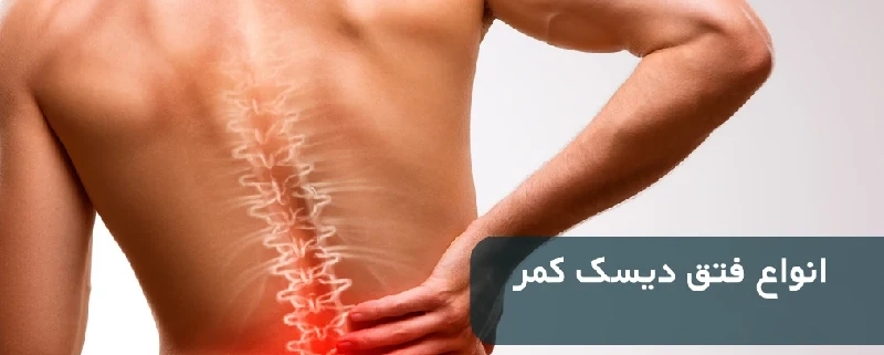انواع بیماری دیسک کمر