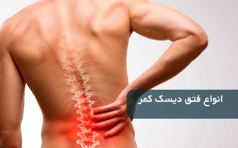 انواع بیماری دیسک کمر
