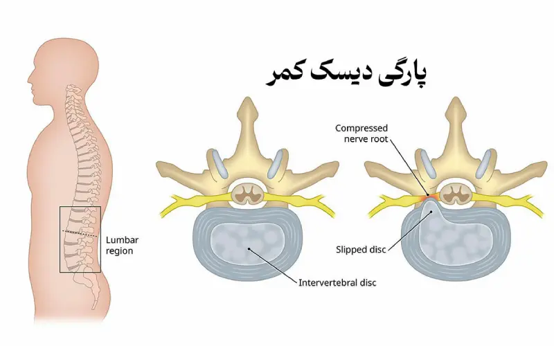 پارگی دیسک کمر
