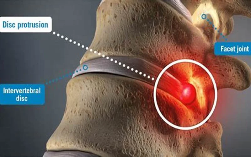 آناتومی دیسک بین مهره ای