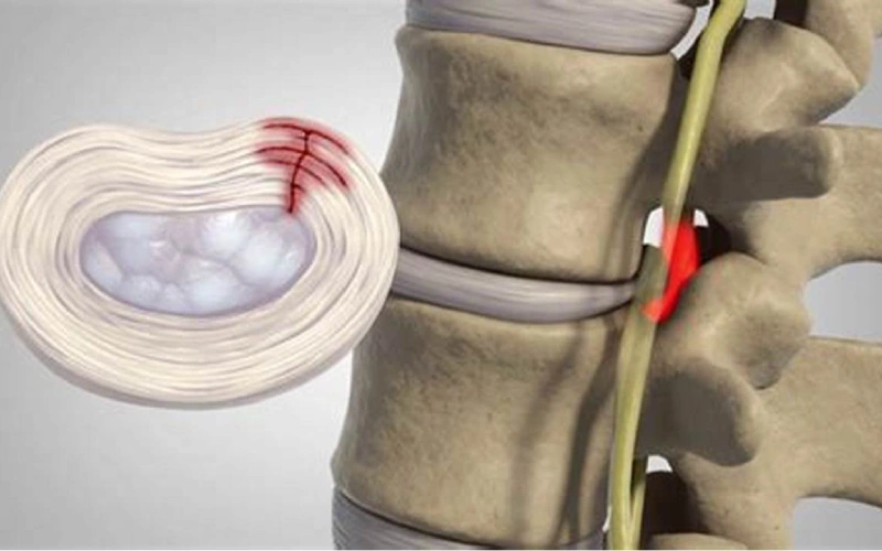 دیسک بین مهره ای چیست؟