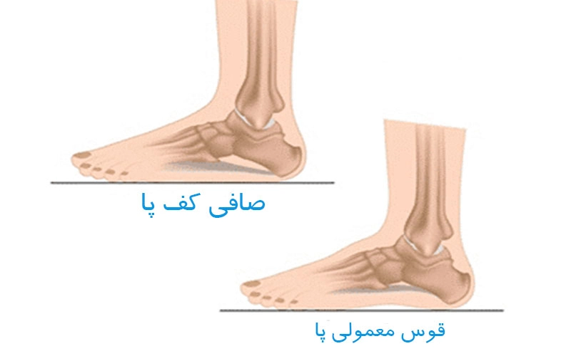 تشخیص صافی کف پا