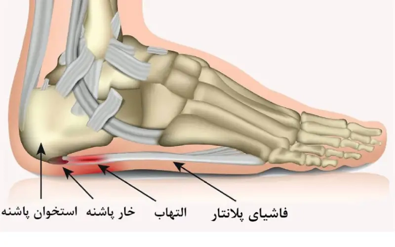 درمان خار پاشنه