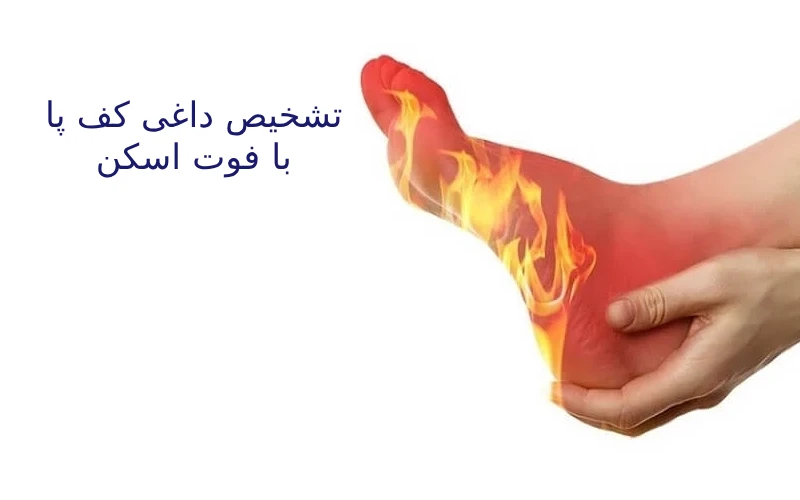 درمان داغی کف پا
