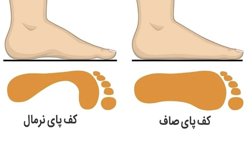 درمان صافی کف پا