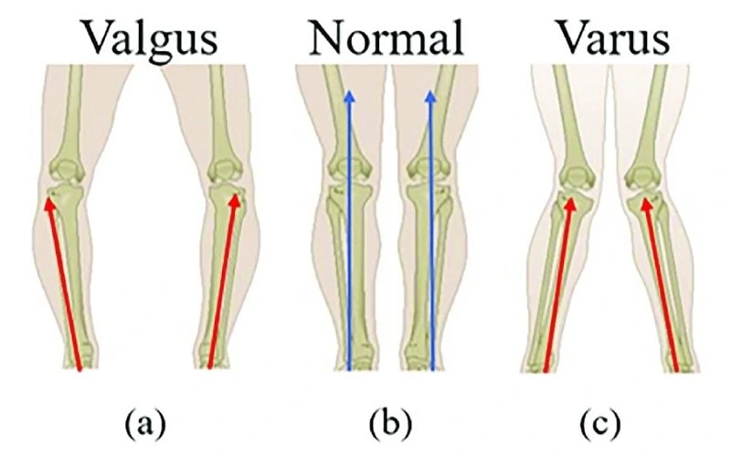 انحراف محوری زانو