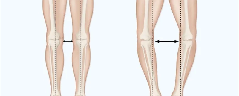 حرکات اصلاحی انحراف زانو به خارج