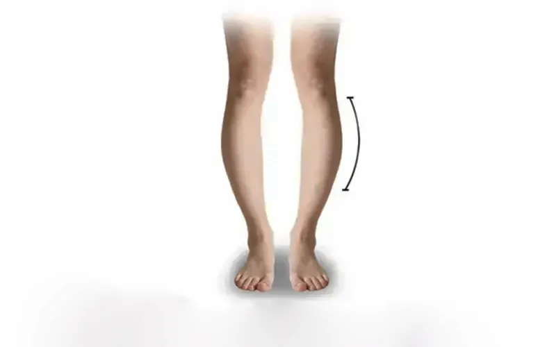 دلیل درمان انحراف زانو به خارج