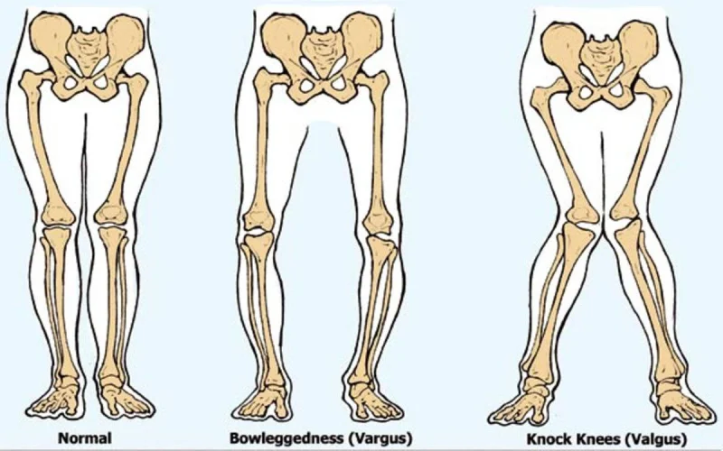 چگونگی تست انحراف زانو