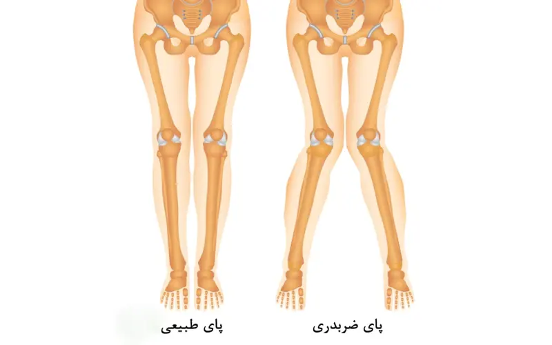 دلایل انحراف زانو به داخل
