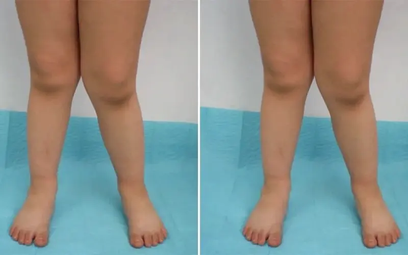 انحراف زانو به داخل